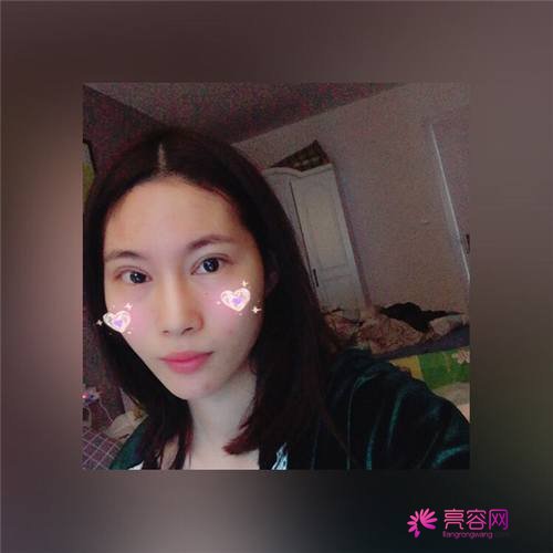 北京亚馨美莱坞张海明双眼皮