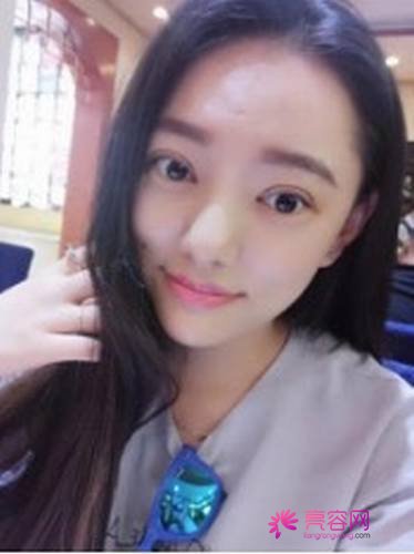 成都美未央周鹏起双眼皮