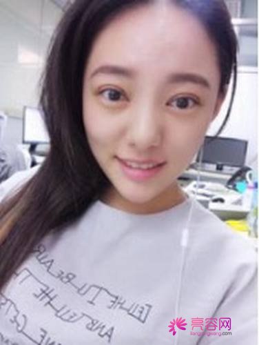 成都美未央周鹏起双眼皮
