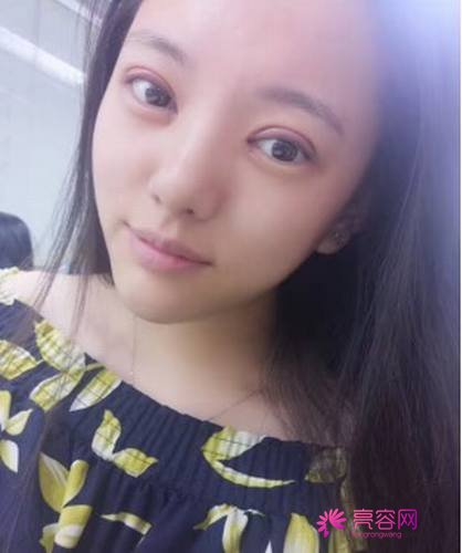 成都美未央周鹏起双眼皮