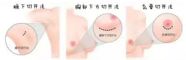 假体隆胸 &amp;自体脂肪隆胸，该怎么选呢？