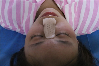 成美,冯春雨,隆鼻,案例,价格,