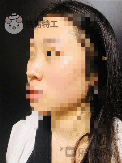 长沙艺星,秦晓东,隆鼻,案例,价格,