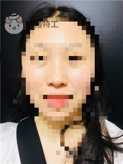 长沙艺星,秦晓东,隆鼻,案例,价格,