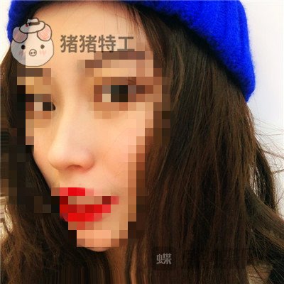 长沙艺星,秦晓东,隆鼻,案例,价格,