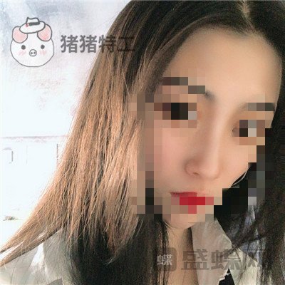 长沙艺星,秦晓东,隆鼻,案例,价格,