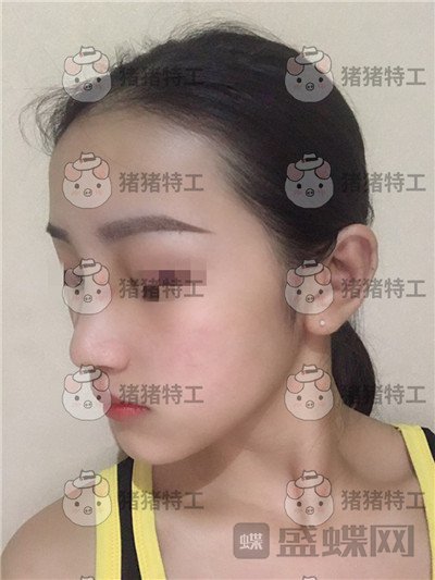 长沙南湖，何怀万，隆鼻，案例，价格，