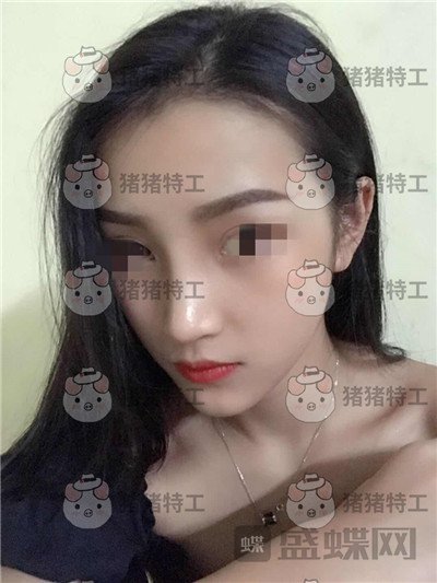 长沙南湖,何怀万,隆鼻,案例,价格,