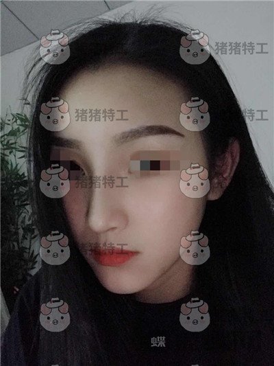 长沙南湖,何怀万,隆鼻,案例,价格,