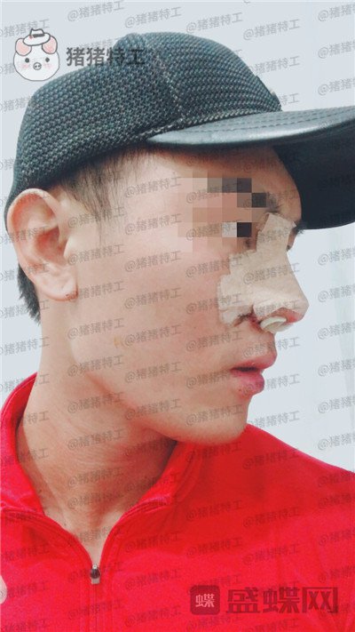 深圳艾妍，徐荣阳，​隆鼻，案例，价格，