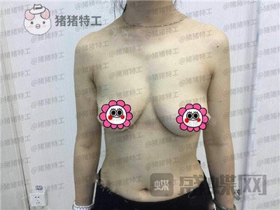 重庆五洲魏恒隆胸案例价格分享,大家看看我做的假体假不假?