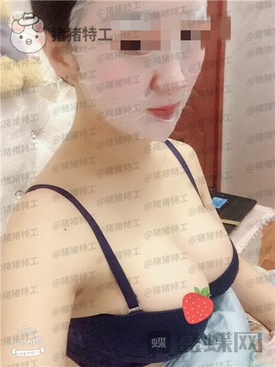 重庆五洲魏恒隆胸案例价格分享,大家看看我做的假体假不假?