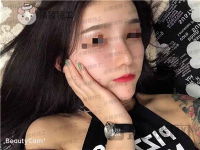 重庆华美，蒋琳​，隆鼻，案例，价格，