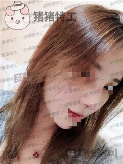 上海艺星,李建兵,隆鼻,案例,价格,