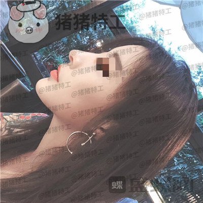 上海艺星,李建兵,隆鼻,案例,价格,