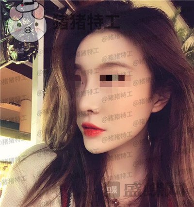 上海艺星,李建兵,隆鼻,案例,价格,