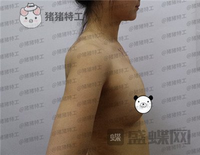 北京英煌项力源隆胸案例价格分享，不仅增大还改良掉下垂真的太惊讶啦！