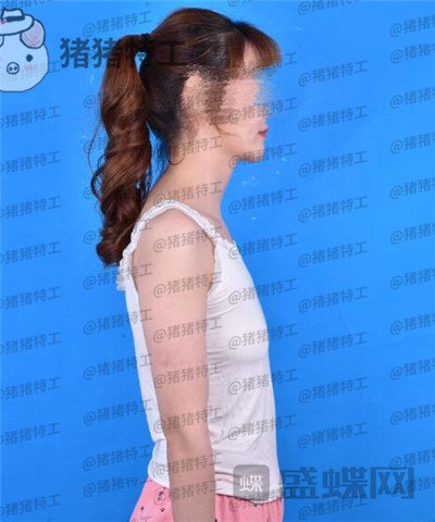 郑州集美刘德辉隆胸案例价格分享，这么好看的胸型真的是婚姻的调味剂~