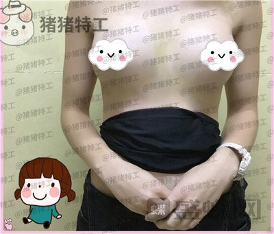 郑州集美刘德辉隆胸案例价格分享，这么好看的胸型真的是婚姻的调味剂~