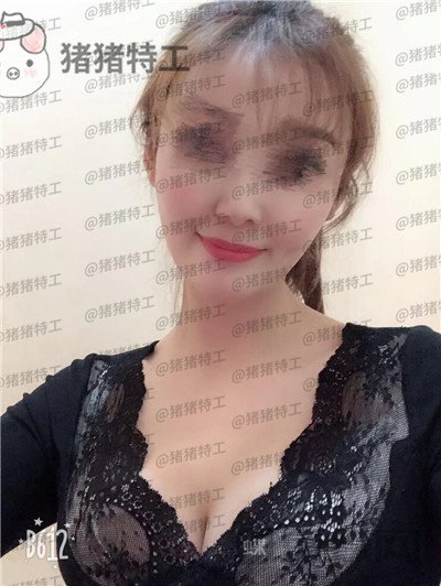 郑州集美刘德辉隆胸案例价格分享，这么好看的胸型真的是婚姻的调味剂~