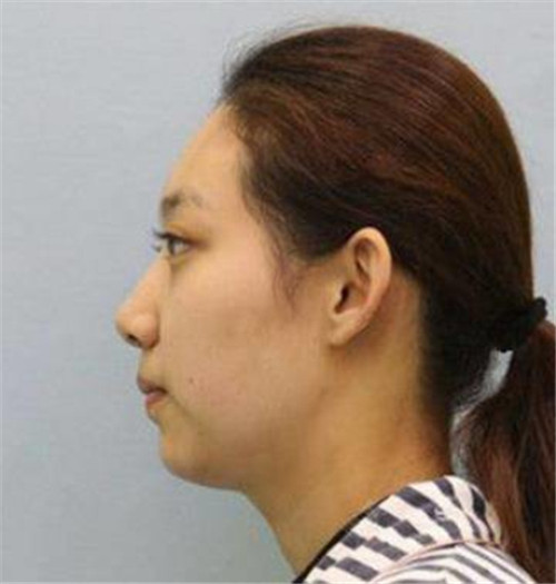 上海华美李健自体脂肪移植怎么样?案例,价格,口碑