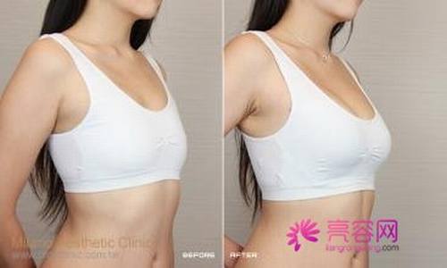 隆胸假体要怎么取出来呢怎么样价格案例