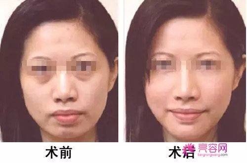 你想去黑眼圈吗?为你详解激光去黑眼圈几次能见