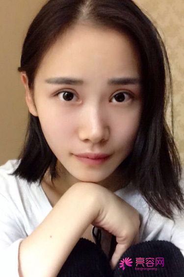 网友小梅割双眼皮两个月真实案例分享