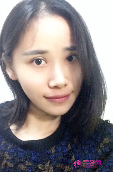 网友小梅割双眼皮两个月真实案例分享