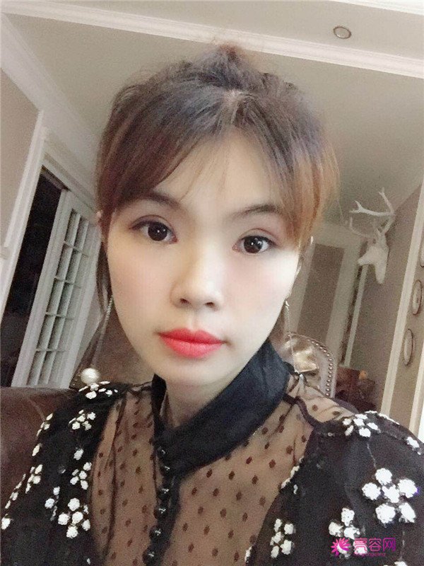 重庆双眼皮案例分享,能有这样的果也是很好看了,安排!!!!
