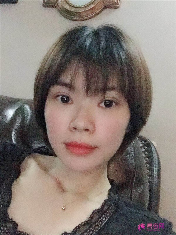 重庆双眼皮案例分享,能有这样的果也是很好看了,安排!!!!