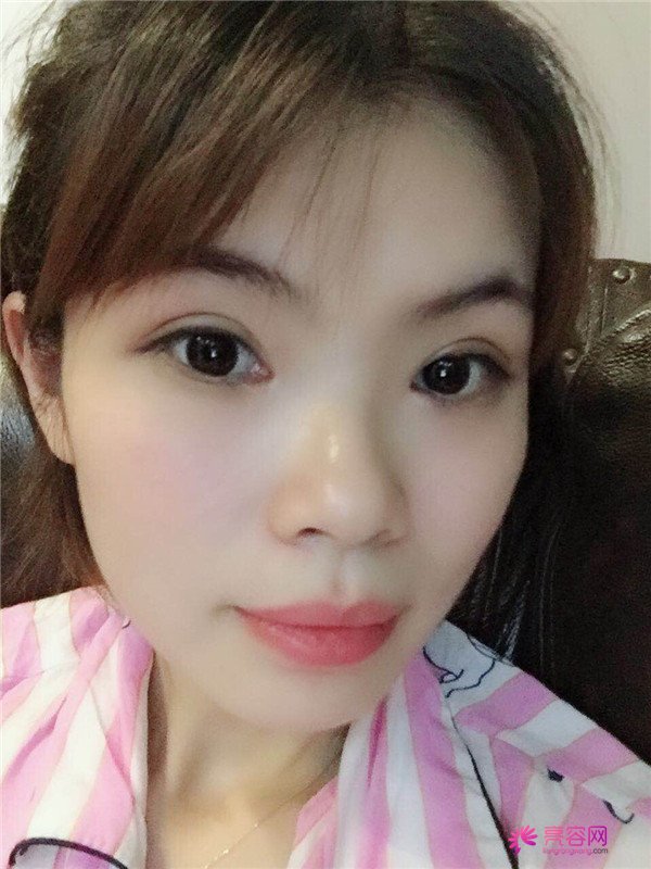 重庆双眼皮案例分享,能有这样的果也是很好看了,安排!!!!
