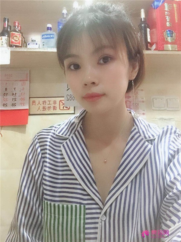 重庆双眼皮案例分享,能有这样的果也是很好看了,安排!!!!