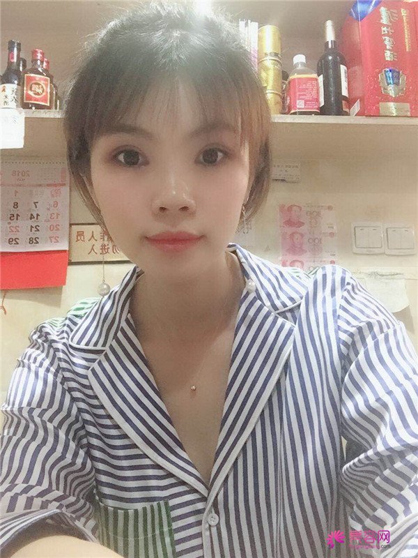 重庆双眼皮案例分享,能有这样的果也是很好看了,安排!!!!