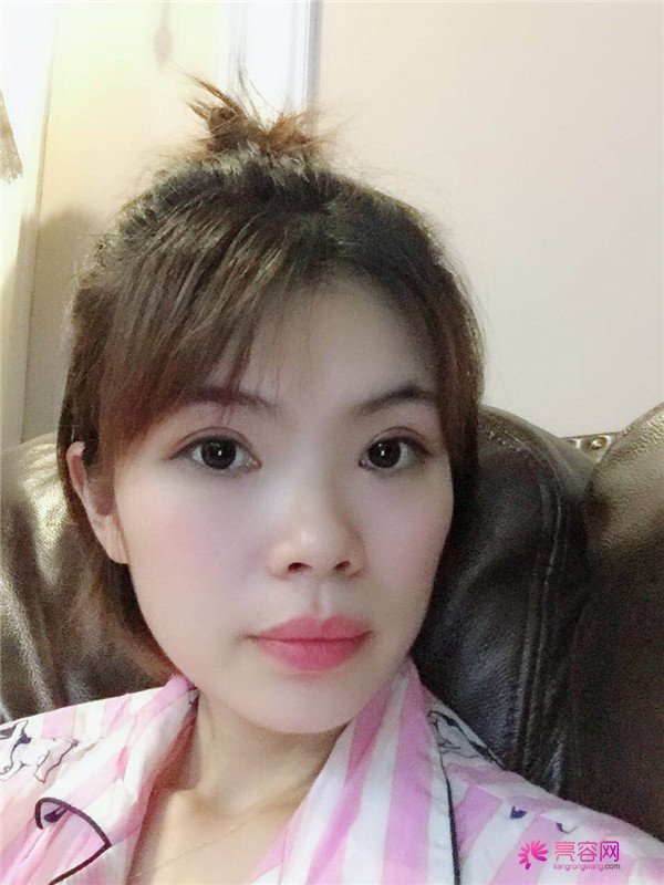 重庆双眼皮案例分享,能有这样的果也是很好看了,安排!!!!