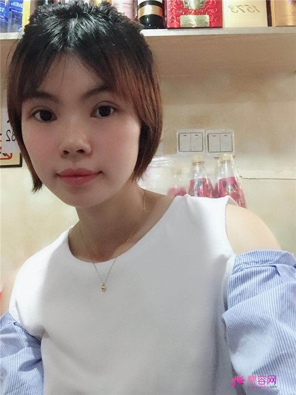 重庆双眼皮案例分享,能有这样的果也是很好看了,安排!!!!