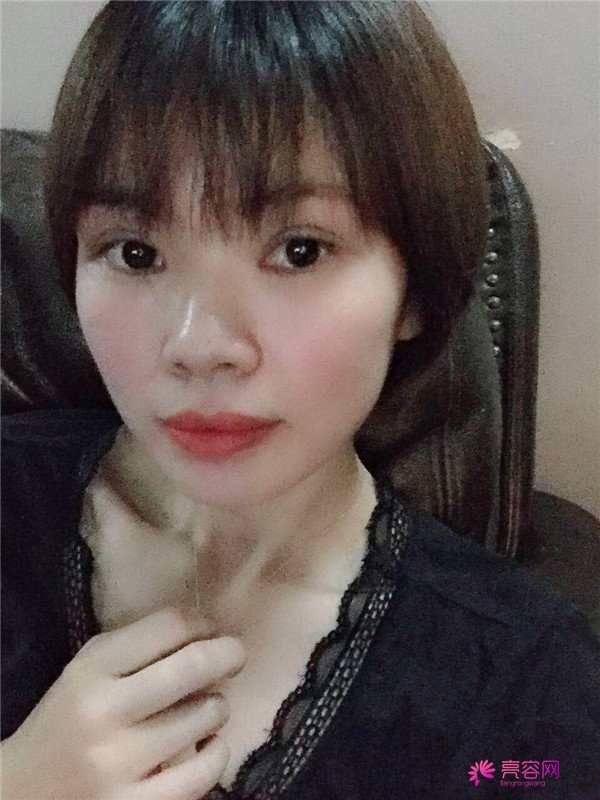 重庆双眼皮案例分享,能有这样的果也是很好看了,安排!!!!