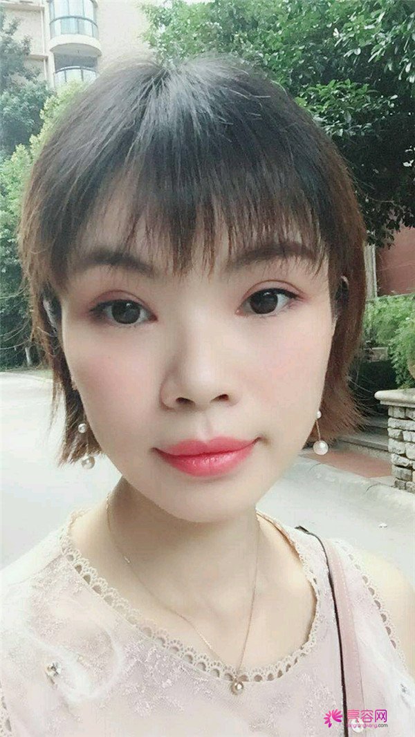 重庆双眼皮案例分享,能有这样的果也是很好看了,安排!!!!