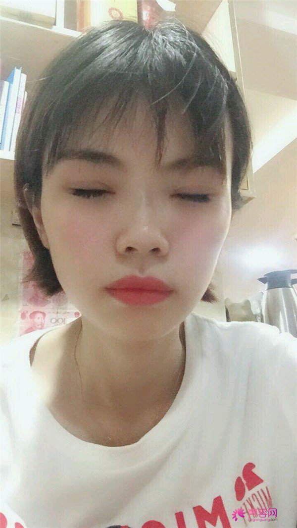 重庆双眼皮案例分享,能有这样的果也是很好看了,安排!!!!