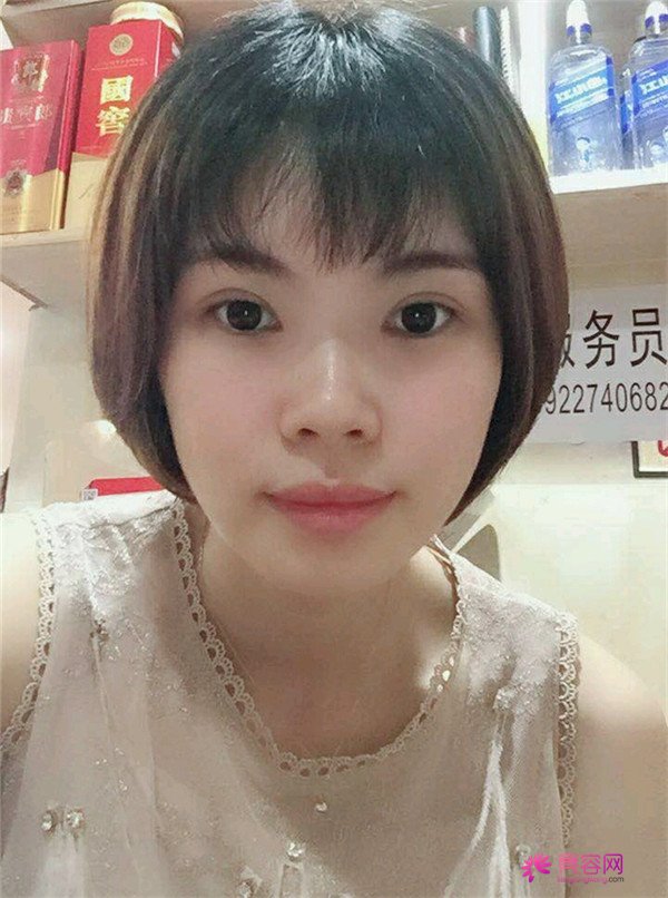 重庆双眼皮案例分享,能有这样的果也是很好看了,安排!!!!