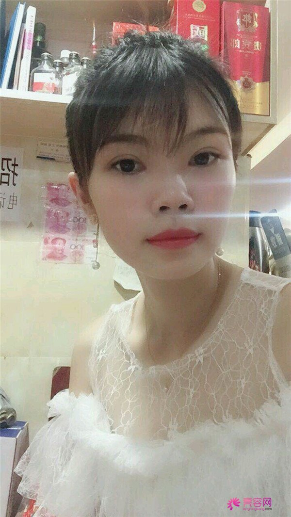 重庆双眼皮案例分享,能有这样的果也是很好看了,安排!!!!