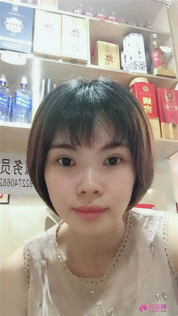 重庆双眼皮案例分享,能有这样的果也是很好看了,安排!!!!