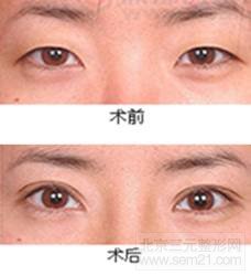 重睑术效果对比图 重睑术效果对比图