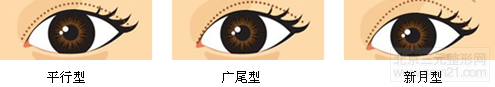 重睑分型 重睑分型