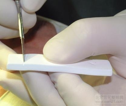 揭秘:整形假体的寿命究竟有多久?