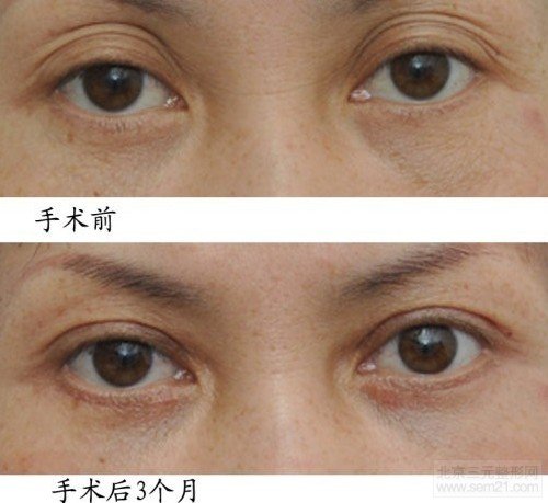 切开双眼皮修复 手术前后对比图 全切双眼皮修复价格和介绍