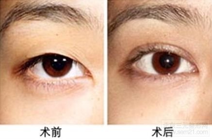 埋线双眼皮修复 手术前后对比图 埋线双眼皮修复价格介绍