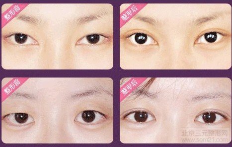 双眼皮修复 手术前后对比图 双眼皮修复价格介绍