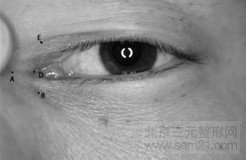 Z成形法内眦开大术 开内眼角价格介绍