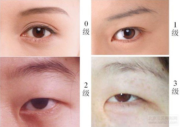 不同程度的內眦赘皮 开内眼角价格介绍